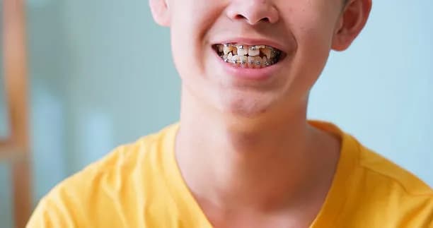 Dental bonding for chipped teeth in Hamilton NJ